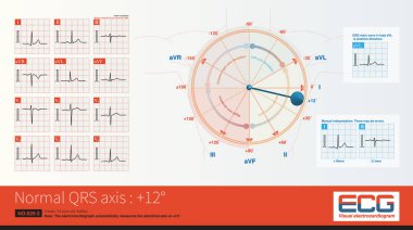 Ön eksen + 12 olduğunda, maksimum QRS depolarizasyon potansiyeli kurşunun eksenine en yakındır, yani R-dalgası genişliği, kurşunun en yüksek.