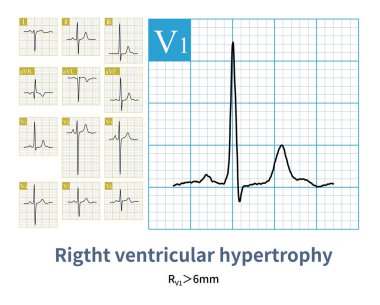 Erkek, 18 yaşında, klinik olarak ductus arteriosus teşhisi konmuş. EKG sağ eksen sapması, sağ atriyal anormallik ve sağ ventriküler hipertrofi gösterdi..