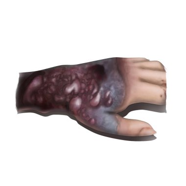 Ebola insan vücudunda yaygın kanamaya ve ölüme neden olabilir. Bu tıbbi illüstrasyon, Ebola hastalarının üst uzuvlarında deri altı kanama ve nekroz olduğunu gösteriyor..