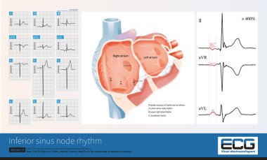 Erkek, 29 yaşında, klinik olarak burun septal malformasyonu teşhisi konulmuş. Preoperatif EKG normal, alt uçlardaki J dalgalarına dikkat edin. Bunlar fizyolojik J dalgaları..