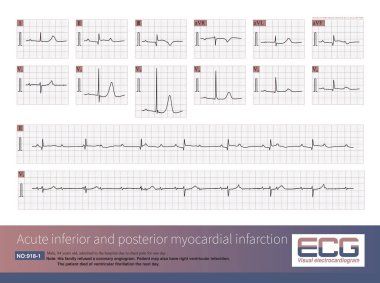 84 yaşında erkek, 1 gün boyunca göğüs ağrısı şikayetiyle hastaneye yatırılmış. EKG akut inferior ve posterior MI gösterdi ve muhtemelen kalp krizi. Hasta ertesi gün ventriküler fibrilasyondan öldü..