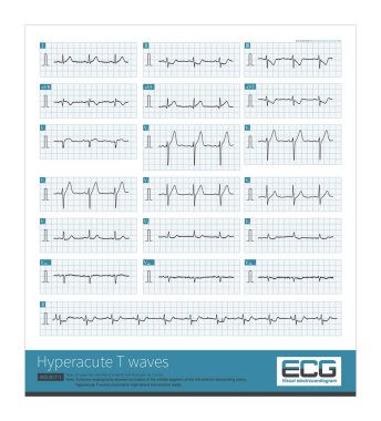 Erkek, 65 yaşında, 2 saat boyunca göğüs ağrısı şikayetiyle hastaneye yatırılmış. EKG hiperakut T dalgaları gösterdi. Koroner anjiyografi sol ön inen arterin orta kesiminin tıkandığını gösterdi..