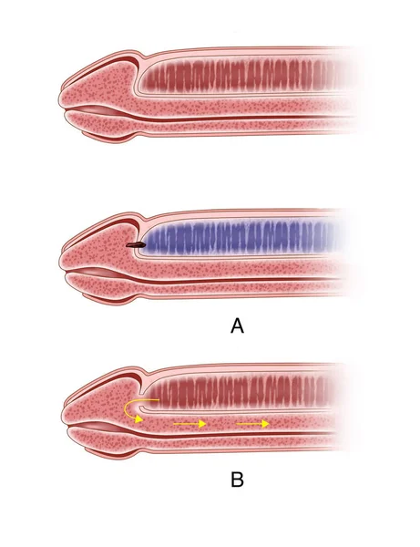 Cavernous Shunt One Surgeries Used Treat Priapism Which Head Penis — Φωτογραφία Αρχείου