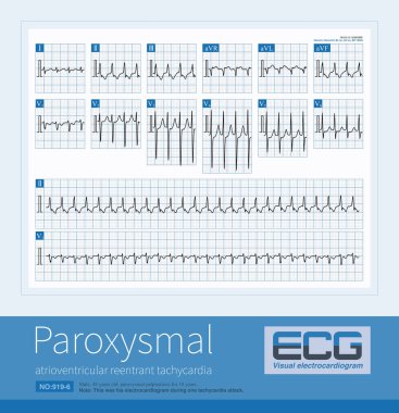 Erkek, 48 yaşında, 10 yıldır kalp çarpıntısı geçiriyor. EKG sol arka septum baypası ve paroksismal supraventriküler taşikardi gösteriyor..