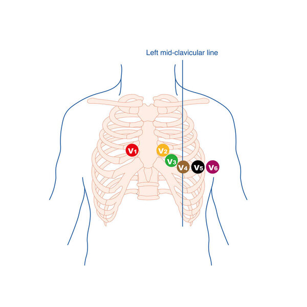 Chest lead is a lead system used to detect the transverse electrical activity of the heart, typically consisting of six electrodes placed in the right and front of the left chest.