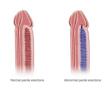 When the penis vein is blocked, it will lead to Priapism of the penis. If the penis is erected for a long time (more than 4 hours), the patient will have pain and other symptoms.