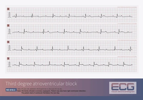 Male, 84 years old, admitted to hospital with chest pain for 1 day. These ECG rhythms are the Holter monitor records of the patients after admission, and they are third degree atrioventricular block.