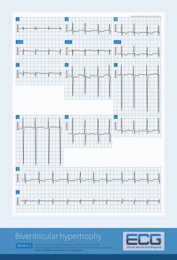 V2-V4 göğüs kurşunundaki QRS dalgası çift fazikse ve 60 mm 'yi aşan bir genişliğe sahipse, biventriküler hipertropinin elektrokardiyogramı hakkında dikkatli olmak gereklidir..