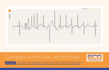 Uzun QT sendromu teşhisi konmuş 4 yaşında bir çocuk. Hastaneye yatırılırken genetik test yapılmadı. Çocuk takip sırasında aniden ölmüş..