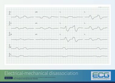 85 yaşında bir kadın, 20 dakikalık ani bilinç kaybından sonra hastaneye yatırılmış. ECG 'ye göre elektriksel mekanik dissosiyasyon bir tür kardiyak arrest..