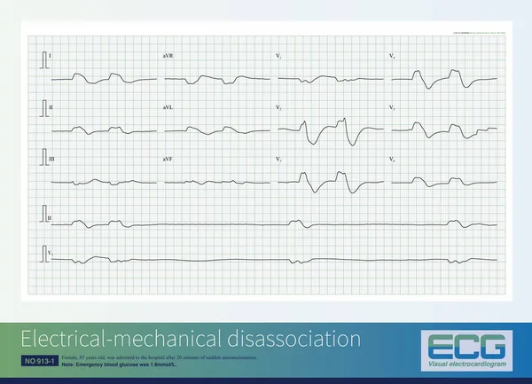 Female, 85 years old, was admitted to the hospital after 20 minutes of sudden unconsciousness. The admission ECG  indicated electrical mechanical disassociation, which is a type of cardiac arrest.