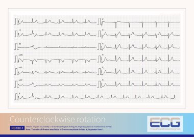 Saat yönünün tersine döndürme yaygın bir ECG olgusudur, V2 ve V3 liderlerinde meydana gelen ve anatomik transmisyonla kötü ilişkili olan SC genlik oranı 1 'den büyüktür.