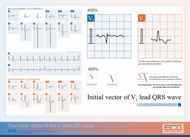 Geniş bir QRS dalgası oluştuğunda, V1 öncü dalgasının aynı ilk vektörü anormal iletkenlik gösterirken, farklar ventriküler ve anormal iletkenlik arasındaki farkı ayırt edemez..