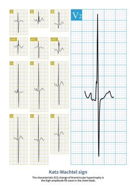19 yaşında, ventriküler septal kusuru olan genç bir adam ikincil akciğer hipertansiyonu geliştirmiş ve elektrokardiyogramı biventriküler hipertropi gösteriyor..