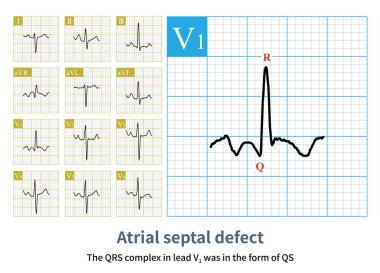 Erkek, 13 yaşında, klinik olarak secundum atrial septal kusur teşhisi konulmuş. Elektrokardiyogramın kurşun V1 'deki QRS dalgasının sağ ventriküler hipertrofi gösteren bir qR şekli olduğuna dikkat edin..