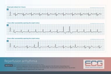 Erkek, 65 yaşında. Klinik tanı, akut anterior duvar miyokardiyal enfarktüsü. Suçlunun kan damarını açtıktan sonra, hasta reperfüzyon aritmisi geliştirdi..