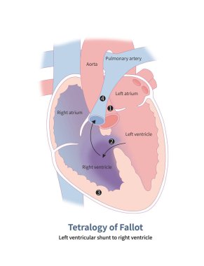 Fallot 'un dört anatomik malformasyonu: 1 aort çıkıntısı, 2 ventriküler septal kusur, 3 sağ ventriküler hipertrop ve 4 pulmoner arter stenoz..