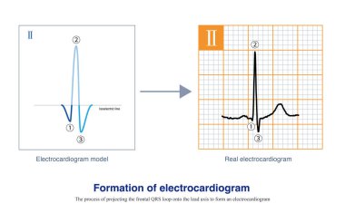 Kurşun eksene bir düzlem vektorkardiyogram yansıtıldığında, bir elektrokardiyogram modeli oluşturulur; elektrokardiyogram modelini gerçek ECG 'yi elde etmek için elektrokardiyogram kağıdına yerleştirilir..