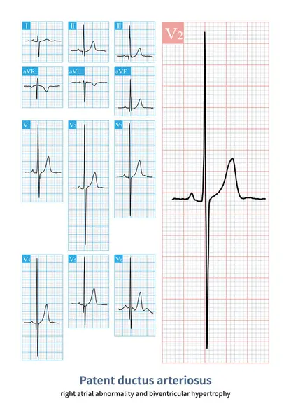 Homem Anos Diagnosticado Clinicamente Com Persistência Canal Arterial Diagnóstico Eletrocardiográfico — Fotografia de Stock