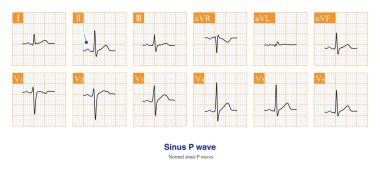 Normal şartlar altında sinüs P dalgası ilk ECG dalgasıdır, çünkü sinüs düğümü çok küçüktür ve elektrik aktivitesi ECG makinesi tarafından kaydedilemez..