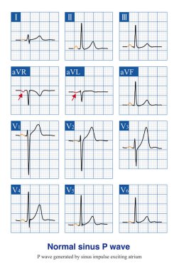 Normal şartlar altında sinüs P dalgası ilk ECG dalgasıdır, çünkü sinüs düğümü çok küçüktür ve elektrik aktivitesi ECG makinesi tarafından kaydedilemez..