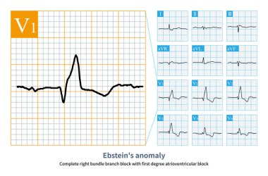 Kadın, 50 yaşında, klinik olarak Ebstein anomalisi teşhisi konulmuş. Elektrokardiyogramda sinüs aritmisi, birinci derece atrioventriküler tıkanıklık ve tam sağ dal bloğu görüldü..