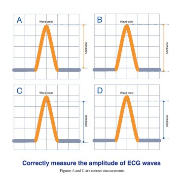 ECG genliğinin doğru ölçümü taban çizgisinin üst kenarından tepe noktasına ya da taban çizgisinin alt kenarından yalağa doğru olmalıdır..