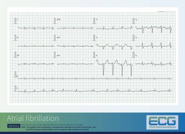 Bu da potasyum normale döndükten sonra hiperkalemi olan hastalarda görülen başka bir EKG. Atriyal fibrilasyon ve tamamlanmamış sağ dal bloğu öneriliyor..