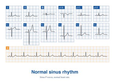 Erkek, 36 yaşında, sağlıklı, ayakta tedavi gören EKG. EKG sinüs ritmi ve normal EKG..