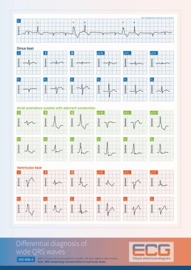 Bu ECG geniş QRS kompleksinin iki morfolojisine sahiptir ve anormal iletkenlik ve ventriküler atımlarla supraventriküler atımların diferansiyel tanısında yer almaktadır..
