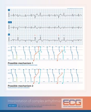 Orta yaşlı bir adam çarpıntılar nedeniyle tıbbi yardım istedi. Elektrokardiyogram aritmiyi gösteriyor. Bu elektrokardiyogramı doğru teşhis edebilir misin??