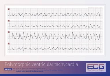 84 yaşında erkek, 1 gün boyunca göğüs ağrısı şikayetiyle hastaneye yatırılmış. EKG akut inferior ve posterior MI gösterdi ve muhtemelen kalp krizi. Hasta ertesi gün ventriküler fibrilasyondan öldü..