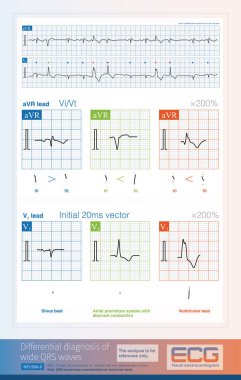 Geniş QRS kompleksinin doğasını analiz ederken, bazı göstergeler farklı ECG ipuçlarında kullanılabilir, ancak analiz her zaman% 100 doğruluk elde edememektedir.