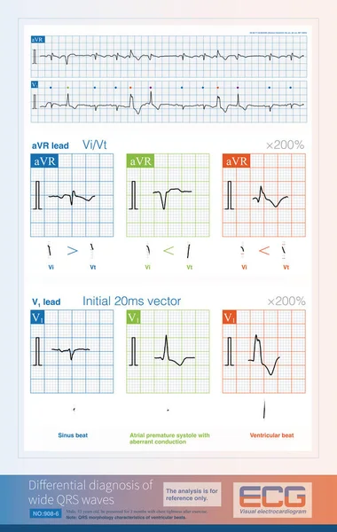 Analyzing Nature Wide Qrs Complex Some Indicators Can Used Different — Stock Photo, Image