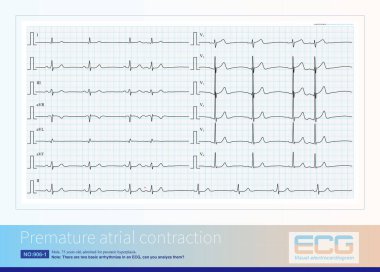 Sinüs bradikardisi ve prematüre atriyal kasılmalar yaşlı yetişkinlerde sık görülen aritmilerdir ve ilki sinüs bradikardisi ile hasta sinüs sendromu arasındaki farkı gerektirir..