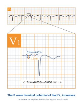 Sol atriyum anormal olduğunda, kurşun V1 P-dalgasının negatif bölümünün uzunluğu ve genliğinin mutlak değeri artar, bu da sol atriyumun işlev bozukluğunu gösterir..