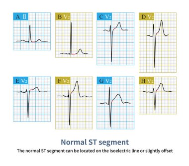 Normal ST segmenti izoelektrik çizgisinde ya da hafif uzaklık üzerinde bulunabilir ve grafikteki J noktası ve ST segmentinin bir kısmı kırmızı eğri ile işaretlenmiştir..