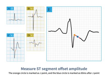 Firstly, select point J as the reference point, and then select 60ms after point J as the measurement point to evaluate the ST segment offset morphology and amplitude. clipart