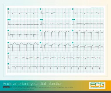 Sol anterior inen arterin açılışı tıkandığında, geniş bir ön miyokardiyal enfarktüs alanına (iç duvarı olan bazı hastalar) neden olabilir ve prognoz zayıftır..