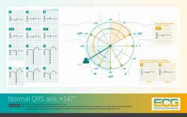 AMI sol ventriküler nekroza neden olduğunda, sol ventrikülün depolarizasyon potansiyeli sağ ventrikülünkinden daha küçüktür ve ECG sağ eksen sapmasını gösterebilir..