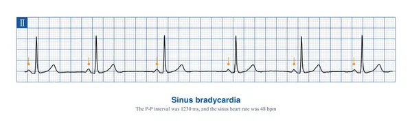 stock image When the frequency of sinus rhythm is less than 60 beats per minute, it is called sinus bradycardia. Severe sinus bradycardia should be suspicious of sick sinus syndrome.