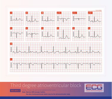 Genç kadınlarda üçüncü derece atrioventriküler blok konjenital olabilir, atrioventriküler düğüm üzerinde ya da onun demetinin çatallaşmasının üzerinde yer alan blok.