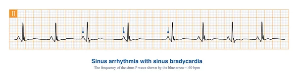 stock image In clinical practice, sinus arrhythmia often occurs together with sinus bradycardia, most of which are physiological rhythm changes and have no therapeutic significance.