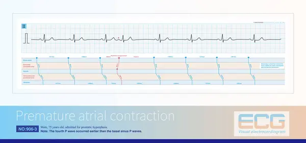 Ecg Diagnosis Atrial Premature Contraction Early Wave Morphology Differs Sinus — Stock Photo, Image