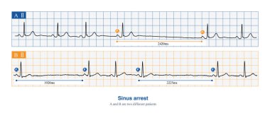 When sinus arrest occurs, the electrocardiogram will show a long P-P interval, which is not multiples of the basal sinus cycle, including physiological and pathological reasons. clipart