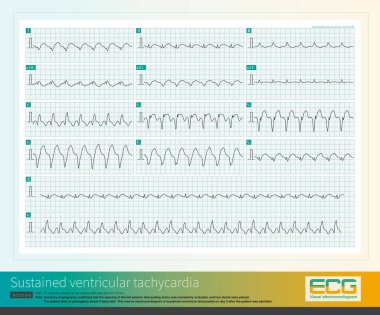 Akut miyokardiyal enfarktüsten sonra, 2 hafta içinde ventriküler taşikardi görülme olasılığı yüksek. Ventriküler taşikardi, miyokard enfarktüsü olan hastalarda yaygın bir ritim bozukluğudur..