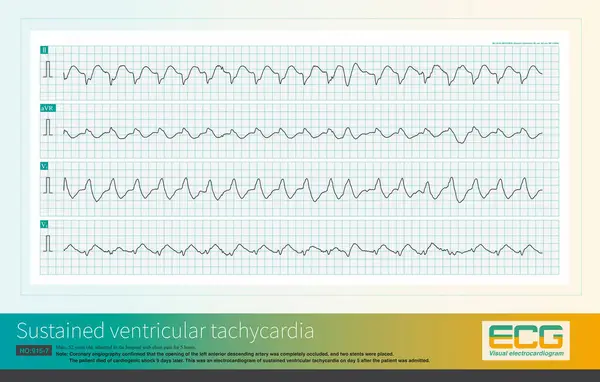 stock image Male, 52 years old, diagnosed with acute extensive anterior wall myocardial infarction. The patient repeatedly experienced ventricular tachycardia and eventually died of cardiogenic shock.