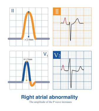 The standard for diagnosing right atrial abnormality in ECG is that the amplitude of P-wave in limb leadsI is greater than 2.5mm, and the amplitude of upright P-wave in chest leads is  1.5mm. clipart