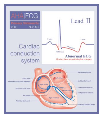 Anormal EKG depolarizasyon dalgaları ve kutuplaşma dalgaları anlamına gelir, bunların çoğu patolojik ve çok azı fizyolojik.