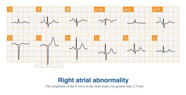 Male, 67 years old, with a clinical diagnosis of chronic obstructive pulmonary disease. ECG showed sinus rhythm and right atrial abnormality. clipart
